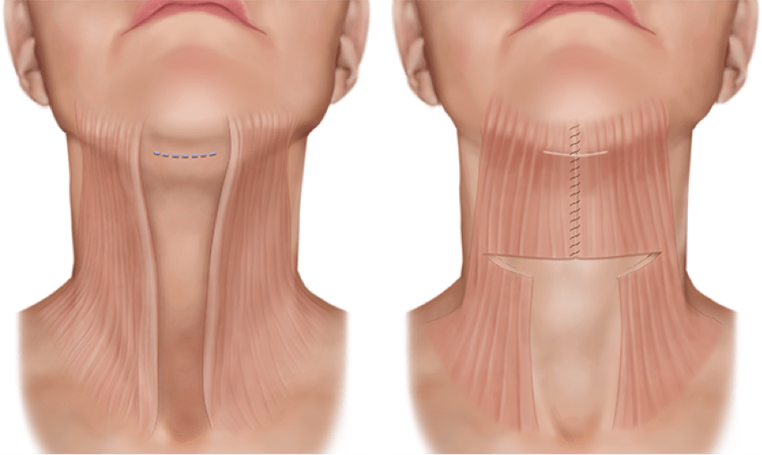 пластика шеи