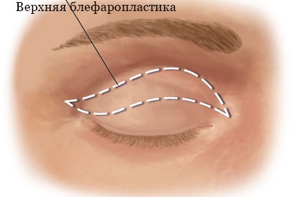 как выглядит веко при верхней блефаропластике