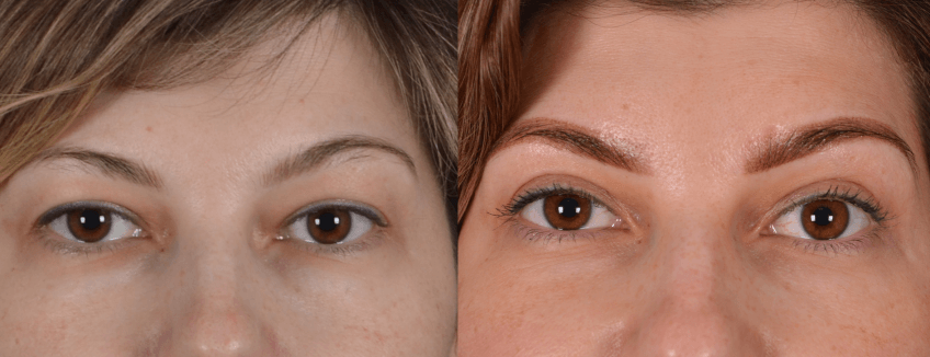 верхняя блефаропластика