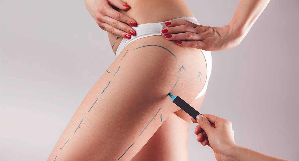 Операция феморопластика