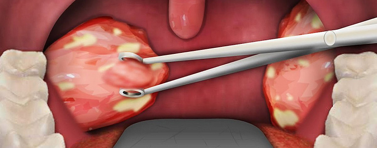 Хронический тонзиллит: причины, симптомы, методы лечения