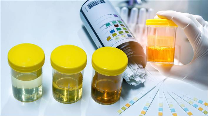 прозрачность мочи