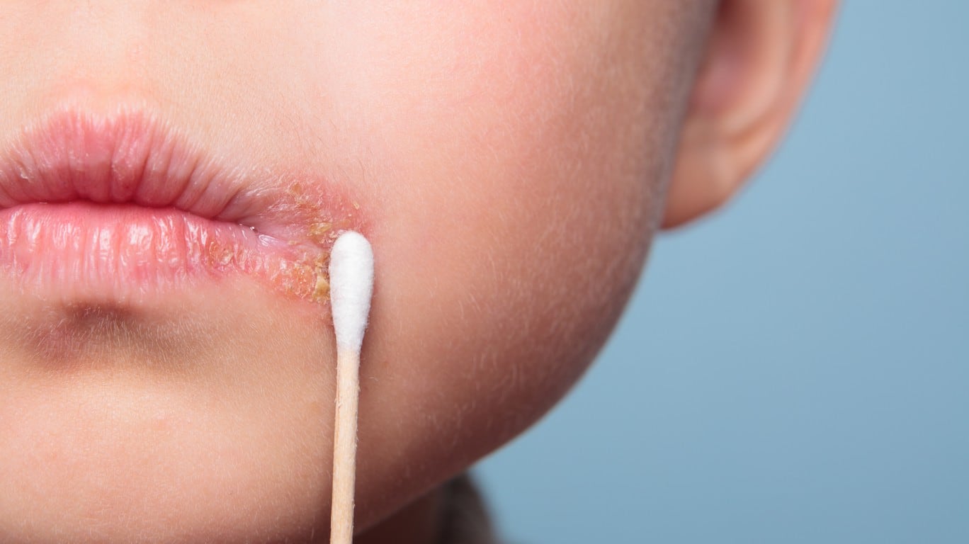 Симптомы герпеса на губе у ребенка