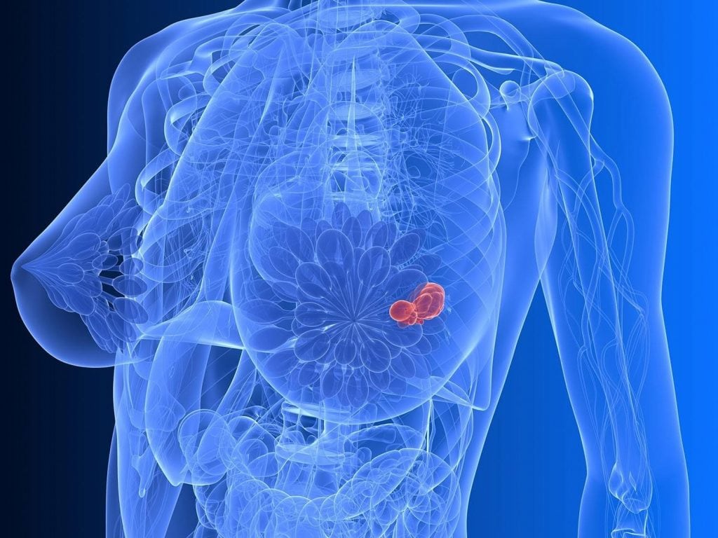Рак груди: эффективность лечения заболевания в Германии