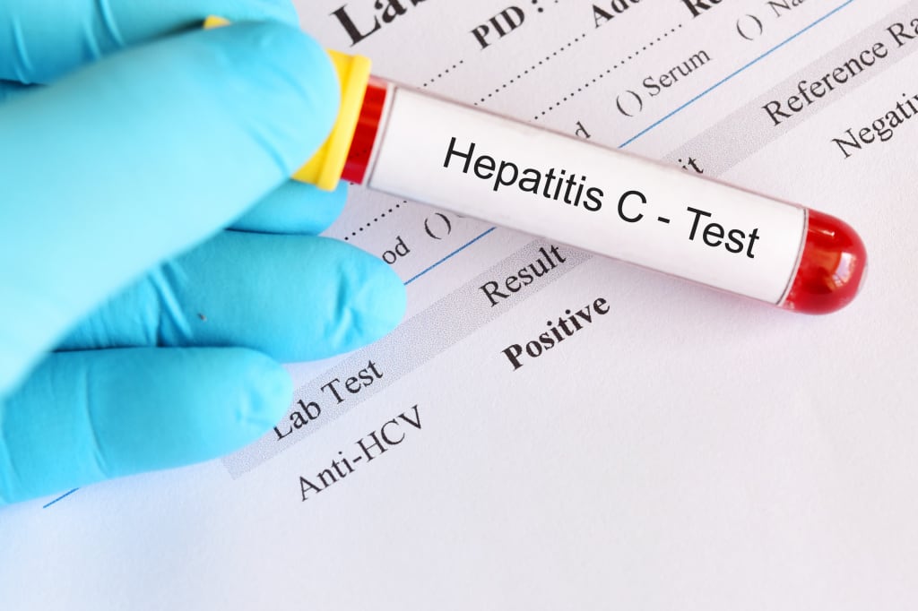 Антитела к вирусу гепатита С (Anti-HCV)