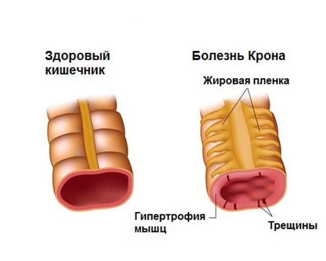 Что такое болезнь Крона и сколько стоит ее лечить