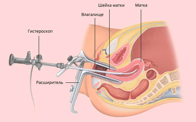 Секс после гистероскопии с РДВ