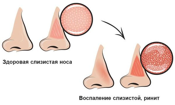 Передний сухой ринит - ЛОР в Самаре - врач Лунёв Андрей Владимирович