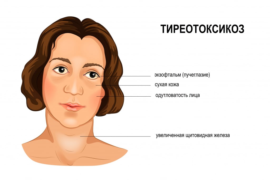 Подострый тиреоидит щитовидной железы - симптомы, причины, лечение