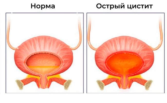 Цистит от переохлаждения: симптомы, диагностика, лечение