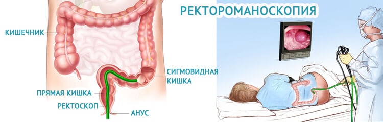 Анальный секс, геморрой, свищи на копчике. А вот и не стыдно!