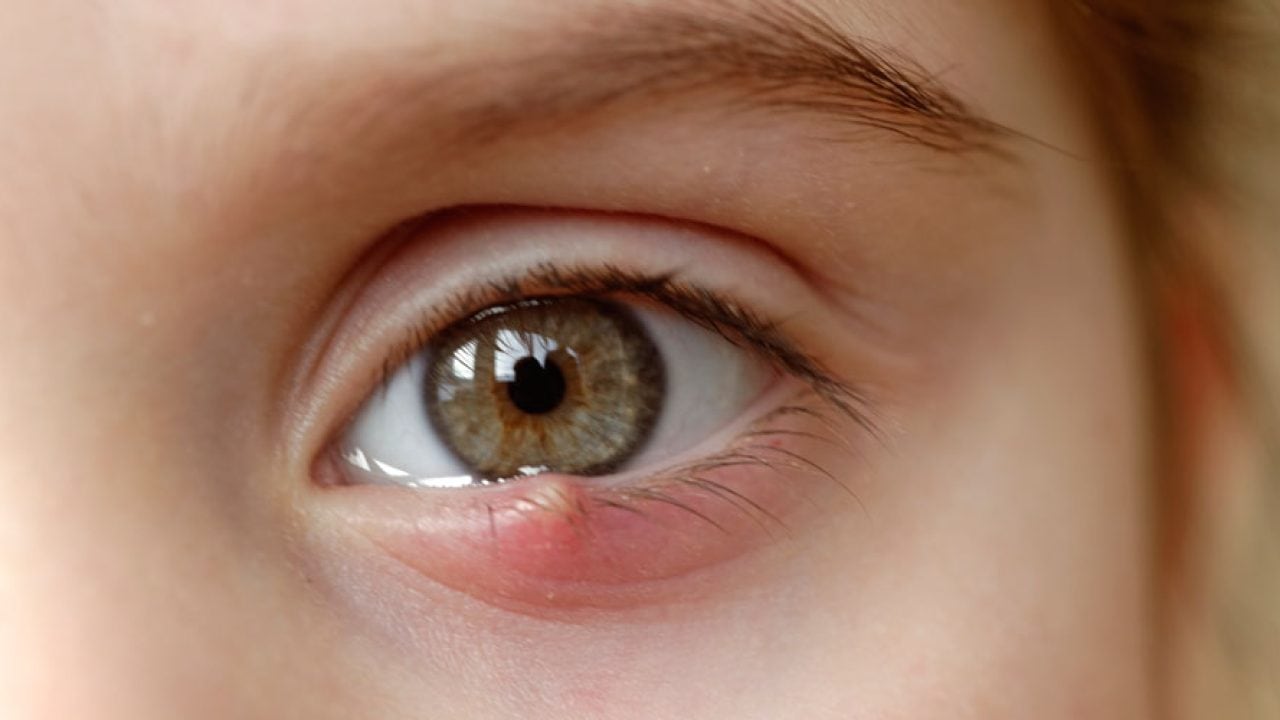 Ячмень на глазу: симптомы, лечение и профилактика