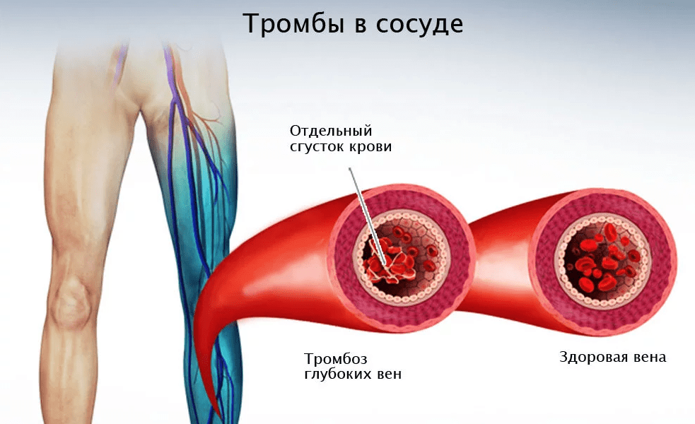 Тромбоэмболия легочной артерии (ТЭЛА) ~ Лечение в Киеве