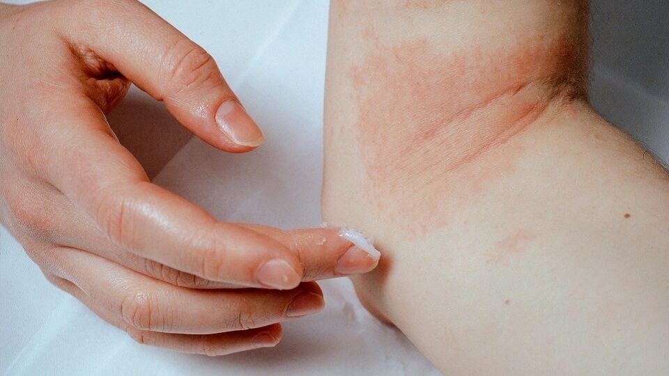 Аллергический дерматит – симптомы и лечение | Клиника ROSH