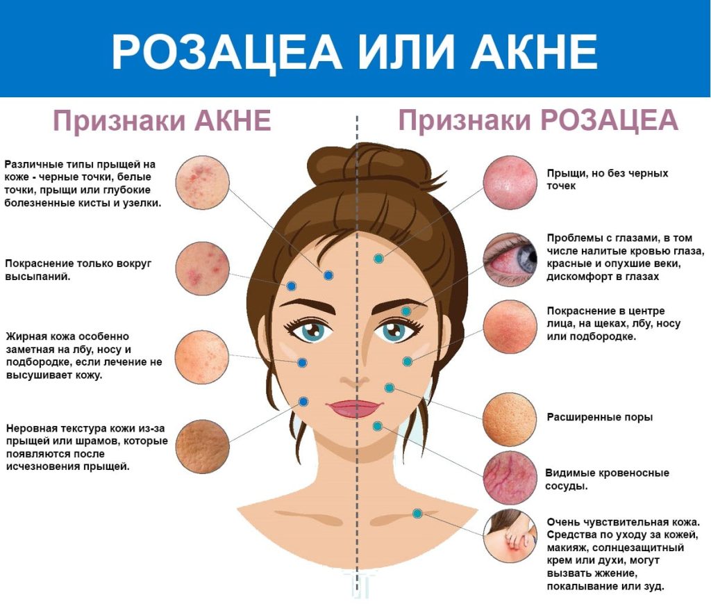 Розацеа на лице: причины, симптомы и методы лечения | Klinik.by